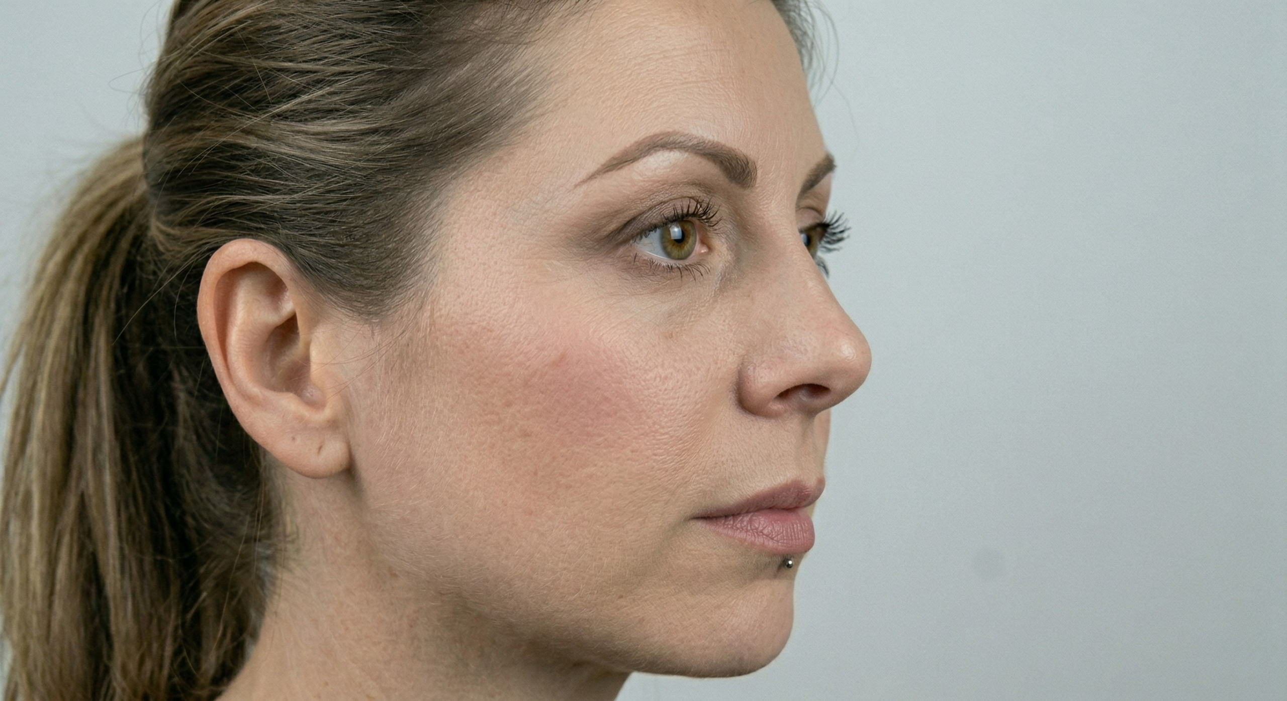 Rhinoplasty after