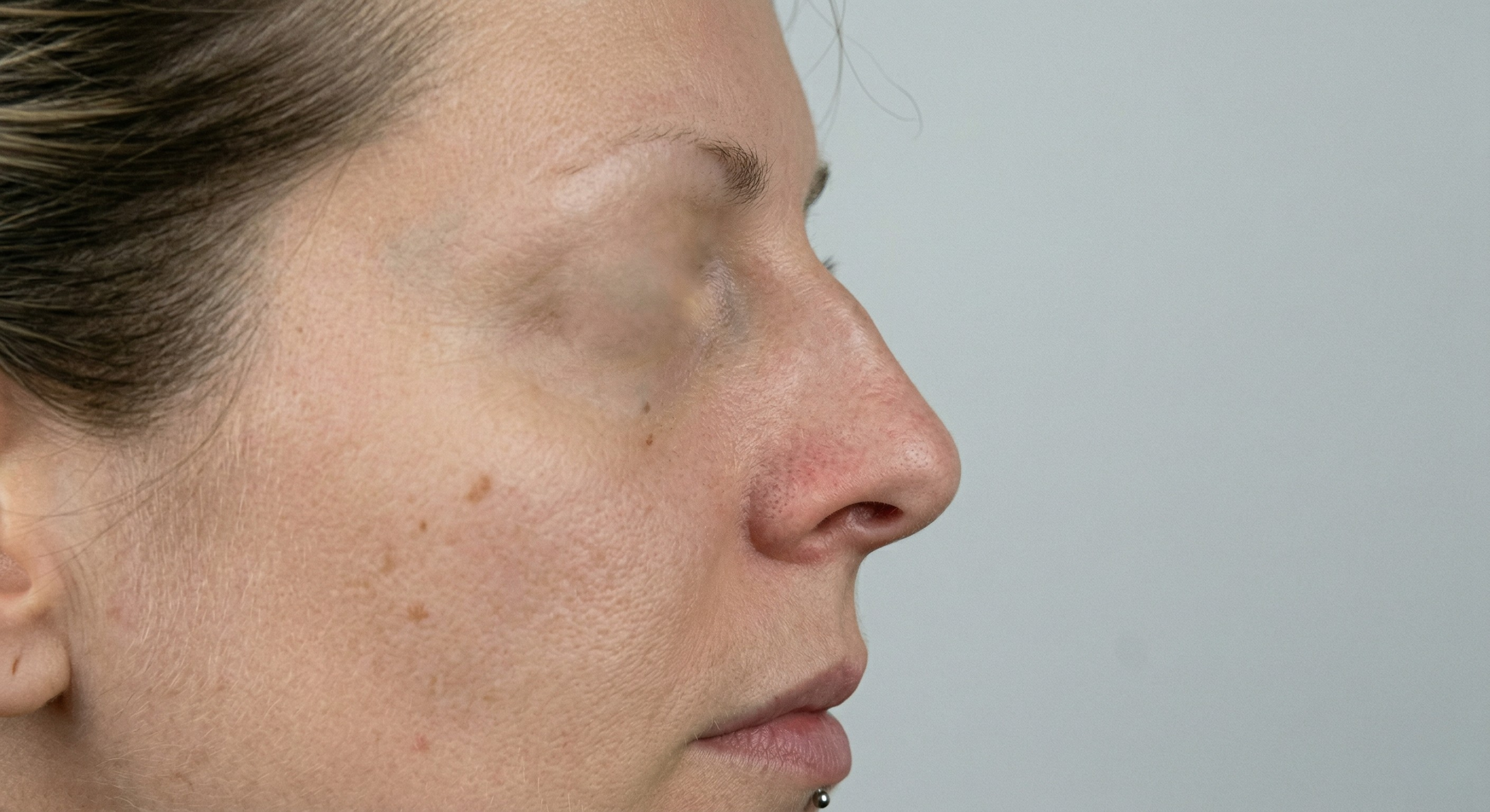 Rhinoplasy before Rhinoplasy before